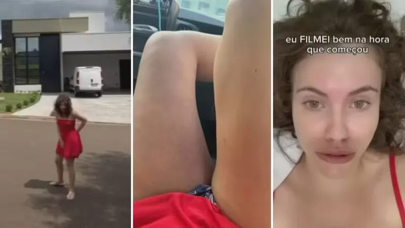 Influenciadora de 21 anos descobre trombose profunda na perna quando produzia vídeo; ASSISTA.
