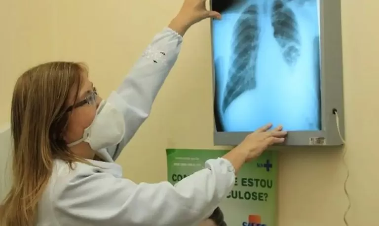 Brasil amplia prevenção e adota tratamentos inovadores para eliminar a tuberculose.