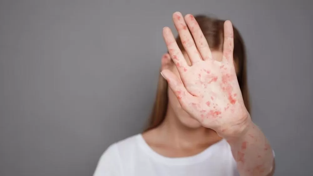 São Paulo confirma primeiro caso de sarampo em 2025.