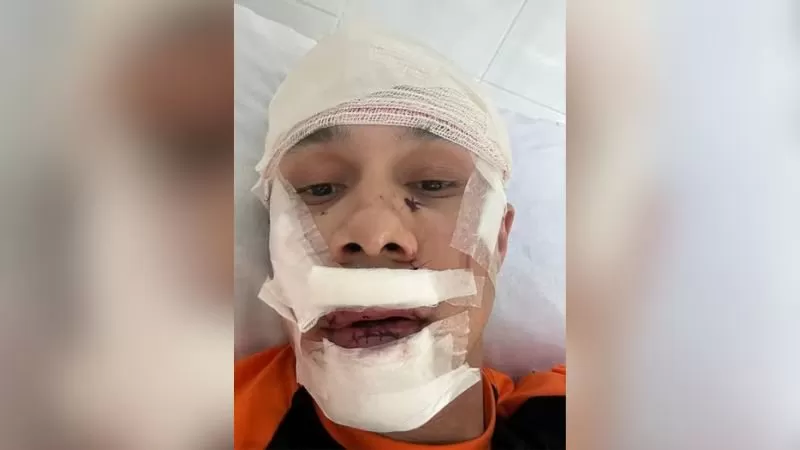 Homem tenta defender mulheres de assédio e é agredido; vítima levou 45 pontos no rosto
