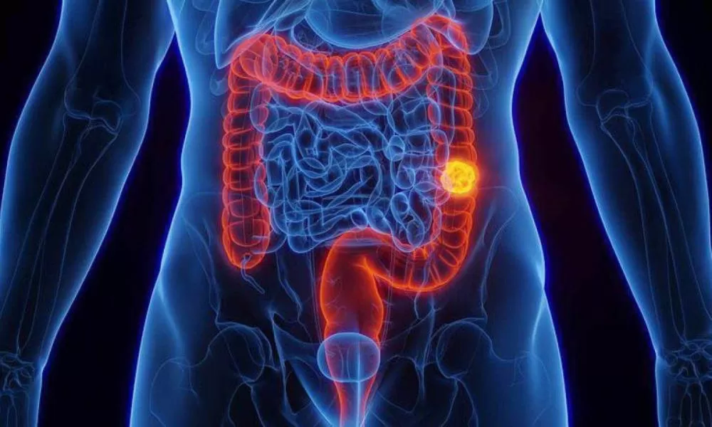 Por que câncer colorretal, que matou Preta Gil, cresce 'assustadoramente' em pessoas de até 50 anos