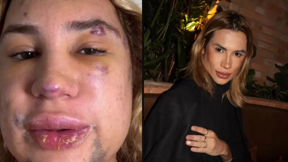 Influenciador morre após complicações de procedimento estético