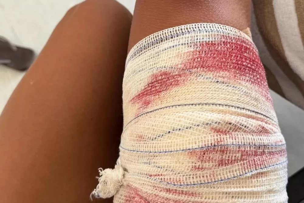 Turista é mordida por tubarão enquanto praticava snorkel em Fernando de Noronha