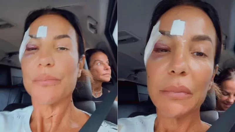 Ivete surge com olho roxo ao receber alta de hospital após acidente doméstico e faz piada com hematomas; veja vídeo