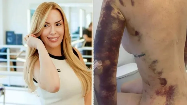 Influenciadora é diagnosticada com transtorno mental após gastar R$ 500 mil em mais de 50 cirurgias.