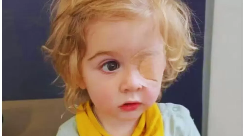 Menino perde a visão de um olho após ser beijado por pessoa com herpes labial.